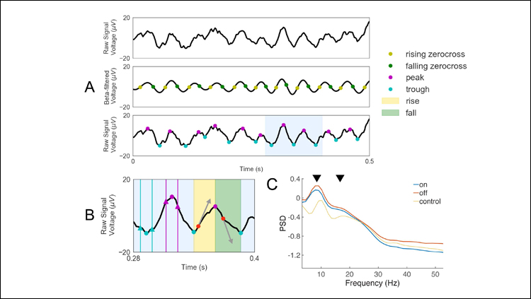 Noninvasive Electrophysiological Biomarker for Parkinson’s Disease