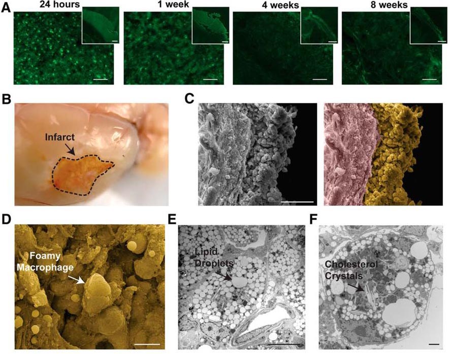 Figure 1. Morphological pathology of liquefactive necrosis up to eight weeks post-ischemia in a mouse model of stroke. (A) Degenerating neurons are observed at the infarct site 24 h, 1 week, 4 weeks, and 8 weeks post-ischemia. (B) At 7 weeks post-ischemia, the infarct site exhibits liquified brain tissue. (C) The area of liquefaction contains a dense population of cells adjacent to the glial scar as imaged by scanning electron microscopy. In the right image, the area of liquefaction is pseudocolored yellow and the glial scar is pseudocolored purple. (D-E) The infarct site contains foamy macrophages (D), lipid droplets (E), and cholesterol crystals (F). (Adapted from Figure 3 in Chung et al. 2018).